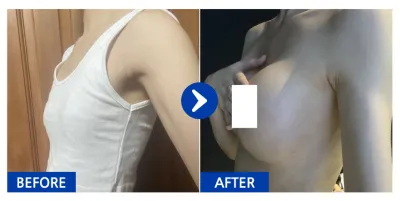 [江南姐姐] 胸部(魔滴) / 第1個月 / 暱稱：綠色草本