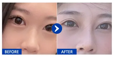 [江南姐姐] 隆鼻 / 術後2個月 / 暱稱：翁啾