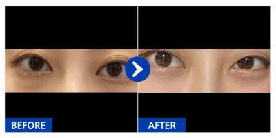 [江南姐姐] 眼底脂肪重置、下眼瞼 / 滿1個月 / 暱稱：난돋규