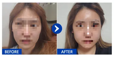 [Babitalk] 顴骨、下頜角 / 第3週 / 暱稱：223345