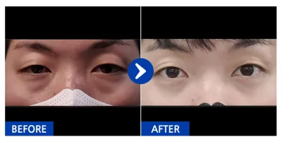 [Babitalk] 眼底脂肪重新配置 / 第1個月 / 暱稱：Hyodyuri