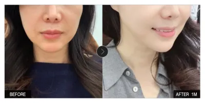 [江南姐姐 評價] 埋線拉提 第1個月 / 暱稱：sooeu