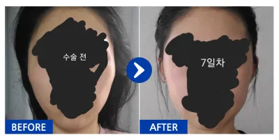 [江南姐姐] 顴骨 / 1個月 / 暱稱：為了肉的肉