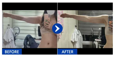 [Babitalk] 抽脂 / 第1個月 / 暱稱：瘋狂兔子