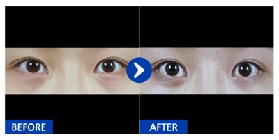 [Babitalk] 雙向開眼角、眼底脂肪重新配置 / 1個月 / 暱稱：喵啊啊啊欸欸唷