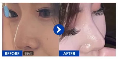 [江南姐姐] 隆鼻 / 1個月 / 暱稱:skfk2299