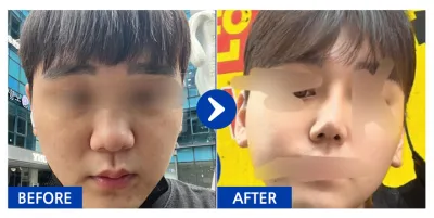 [江南姐姐] 隆鼻 / 第2個月 / 暱稱：鼻子是我的煩惱