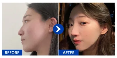 [Babytalk] 隆鼻 / 1年 / 暱稱：atmospe