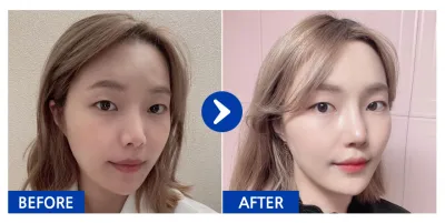 [江南姐姐] 鼻部修復手術 / 術後1個月 / 暱稱：ohnee5