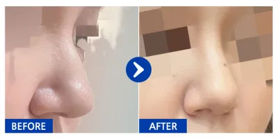 [江南姐姐] 鼻部修復 / 術後1個月 / 暱稱：jjjejjj