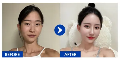 [江南姐姐] 眼部修復手術、眼底脂肪重新配置、鼻部、輪廓2項（顴骨、下頜角）、胸部（魔滴）、脂肪移植（額頭、蘋果肌） / 術後1個月 / 暱稱：듀두듀듀