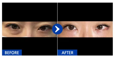 [Babitalk] 眼底脂肪重置 / 1個月 / 暱稱：yoouii