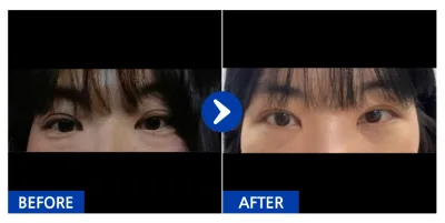 [江南姐姐] 眼底脂肪重新配置 / 1個月 / 暱稱：金ㅇ賢