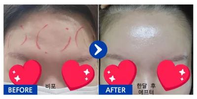 [Babitalk] 額頭脂肪移植 / 1個月 / 暱稱：Paparon