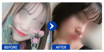 [江南姐姐] 隆鼻手術滿一個月 / 暱稱：v1nnn