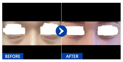 [江南姐姐] 眼底脂肪重新配置 滿1個月 / 暱稱：iil1ili