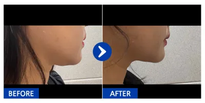 [江南姐姐] 面部抽脂第1個月 / 暱稱：mj_park