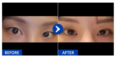 [江南姐姐] 自然黏連（雙眼皮）滿1個月 / 暱稱：殺手練習生