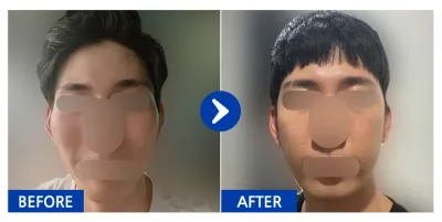 [江南姐姐] 顴骨術後1個月 / 暱稱：firnrb_