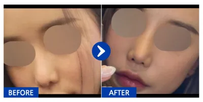 [江南姐姐] 鼻修復手術第1個月 / 暱稱：huisll_day