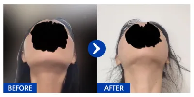 [江南姐姐] 顴骨手術第1個月 / 暱稱：哈哈哈哈哈哈哈馬