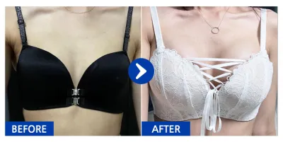 [Babitalk] 隆乳 (魔滴 350cc) 第4個月 / 暱稱：變漂亮吧