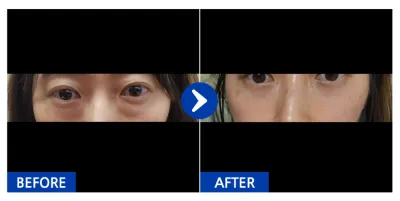 [江南姐姐] 眼底脂肪重新配置、蘋果肌脂肪移植 第1個月 / 暱稱：拉拉拉郎因