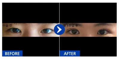 [江南姐姐] 雙眼皮(埋線) 第1週 / 暱稱：嘟嘟噠噠