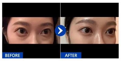 [江南姐姐] 眼底脂肪重置 1個月_liina_