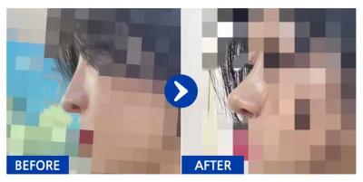 [江南姐姐] 隆鼻手術1個月_aaaa1212