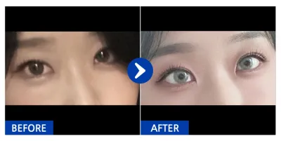 [江南姐姐] 眼底脂肪重置 / 1個月 / 暱稱：hyupp_