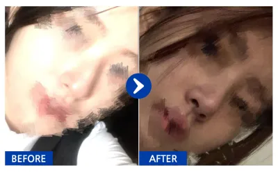 [Babitalk] 隆鼻第1個月 / 暱稱：貓咪gRtzK