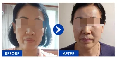 [Babitalk] 埋線拉提 第1個月 / 暱稱：냥이b6sKx