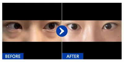 [江南姐姐] 眼底脂肪重置 / 1個月 / 暱稱：castle030