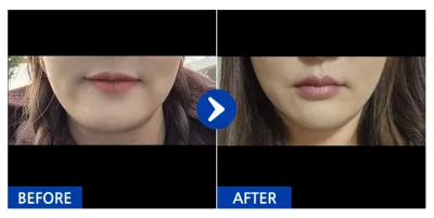 [江南姐姐] 埋線拉提第1個月 / 暱稱：李美善.