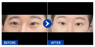 [江南姐姐] 眼袋脂肪重置 / 1個月 / 暱稱：쟝쟝59