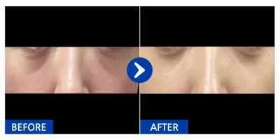 [江南姐姐] 眼底脂肪重新配置 / 1個月 / 暱稱：拉麵紫菜包飯辣炒年糕