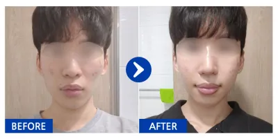 [江南姐姐] 下顎角、顴骨、鼻子 / 1個月 / 暱稱：chgvv