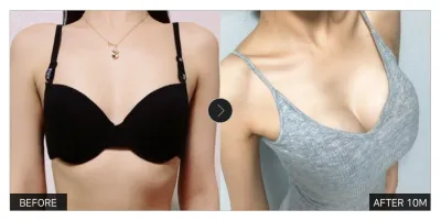 [江南姐姐 心得] 隆乳第10個月 / 暱稱：그마아아안