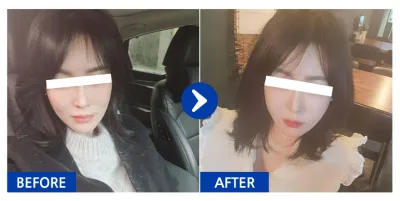 [Babitalk] 全臉脂肪移植、埋線拉提 / 第2週 / 暱稱：갱쥐zXzo