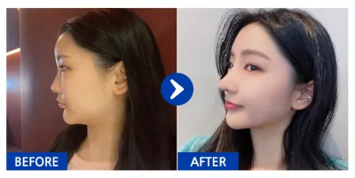 [江南姐姐 評價] 隆鼻 / 第1個月 / 暱稱：寧伊庫庫當