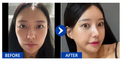 [江南姐姐評價] 輪廓三項（顴骨、下巴、下顎角）、鼻整形 / 第3週 / 暱稱：朴天天