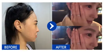 [江南姐姐 心得] 隆鼻重修 / 第3週 / 暱稱：하이루익바