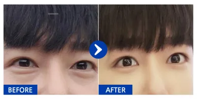 [江南姐姐] 眼底脂肪重置 1個月 / 暱稱：Chris