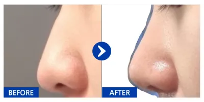 [江南姐姐] 鼻 / 1個月 / 暱稱：nacola