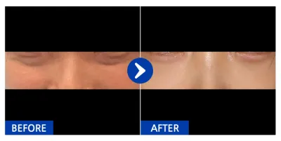 [江南姐姐] 眼底脂肪重置 1個月 / 暱稱：미ㅣ미미미ㅣ