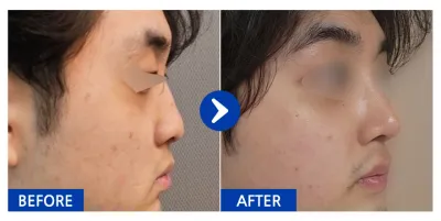 [江南姐姐] 隆鼻 / 第1個月 / 暱稱：乾芒果愛好者