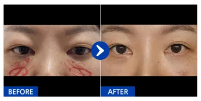 [江南姐姐] 眼下脂肪重新配置 / 1個月 / 暱稱：유리알76