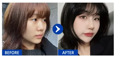 [Babitalk 心得] 隆鼻 / 第1週 / 暱稱：나나나나나난니