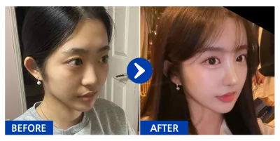 [江南姐姐心得] 隆鼻、額頭脂肪移植 / 第1週 / 暱稱：喵喵喵嗚嗚